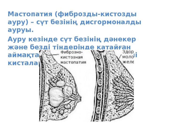 Мастопатия (фиброзды-кистозды ауру) – сүт безінің дисгормоналды ауруы.  Ауру кезінде сүт безінің дәнекер