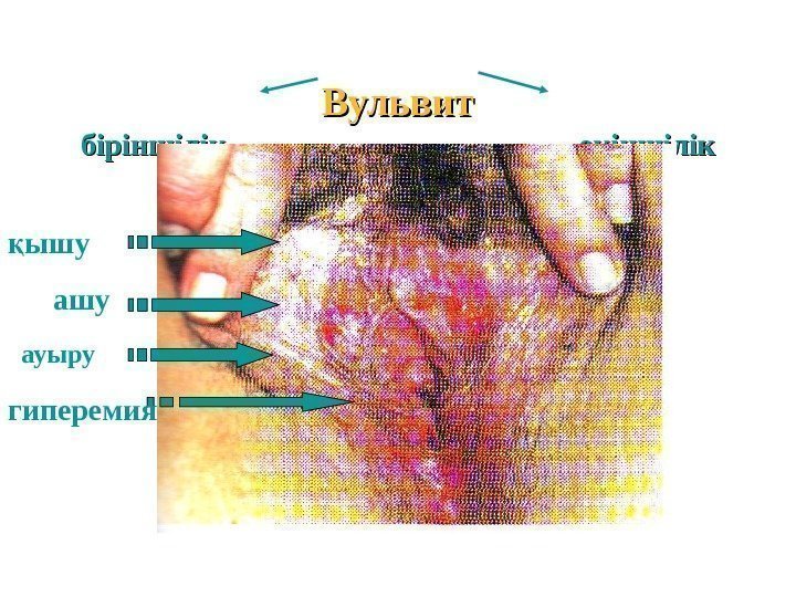 Вульвит біріншілік    екіншілік ышуқ ашу ауыру гиперемия 