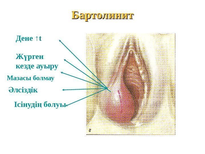 Бартолинит Дене ↑ t  Ж рген ү кезде ауыру Мазасы болмау лсіздік Ә