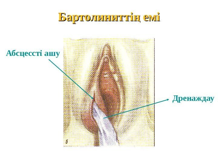 Бартолинитті емің Абсцессті ашу Дренаждау 