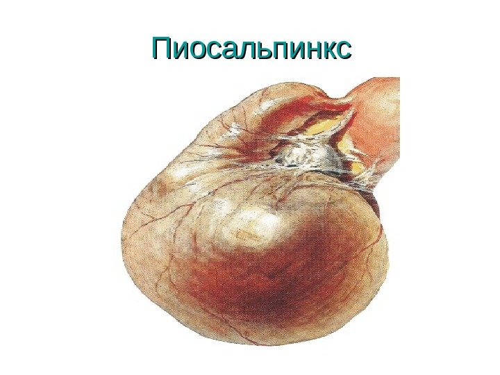 Пиосальпинкс 