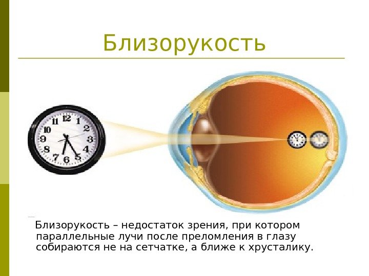   Близорукость – недостаток зрения, при котором параллельные лучи после преломления в глазу