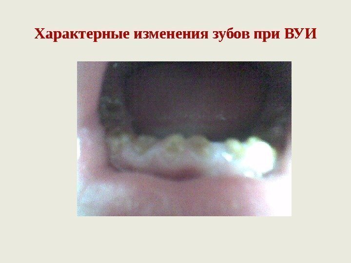 Характерные изменения зубов при ВУИ 