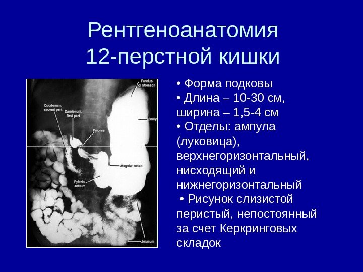Рентгеноанатомия 12 -перстной кишки •  Форма подковы  •  Длина – 10