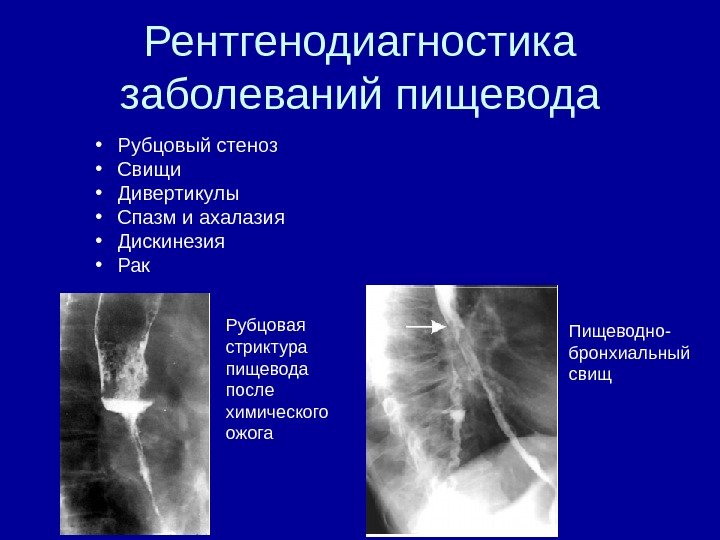 Рентгенодиагностика заболеваний пищевода • Рубцовый стеноз • Свищи • Дивертикулы • Спазм и ахалазия