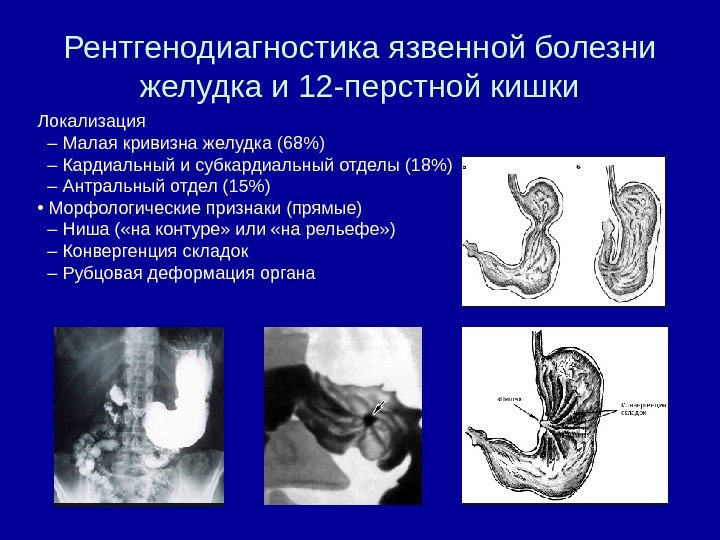 Рентгенодиагностика язвенной болезни желудка и 12 -перстной кишки Локализация  – Малая кривизна желудка