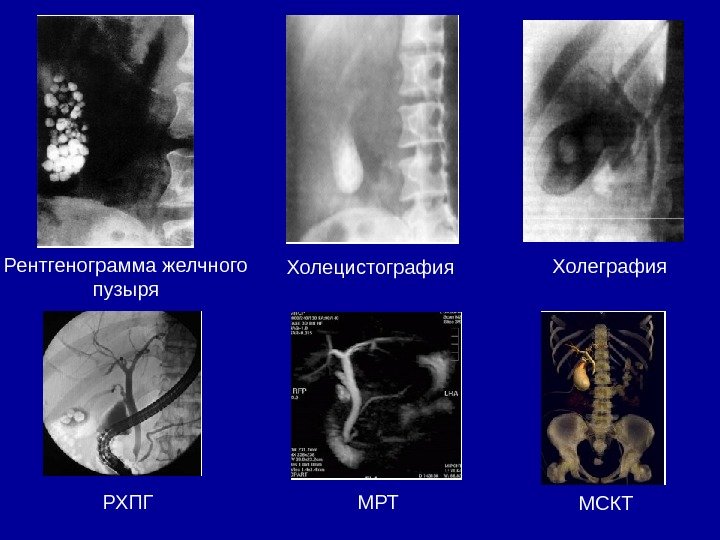 Рентгенограмма желчного пузыря Холецистография Холеграфия  РХПГ МРТ МСКТ 