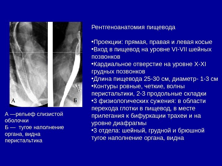 Рентгеноанатомия пищевода • Проекции: прямая, правая и левая косые • Вход в пищевод на