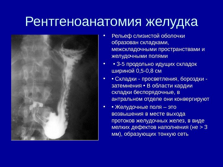 Рентгеноанатомия желудка • Рельеф слизистой оболочки образован складками,  межскладочными пространствами и желудочными полями