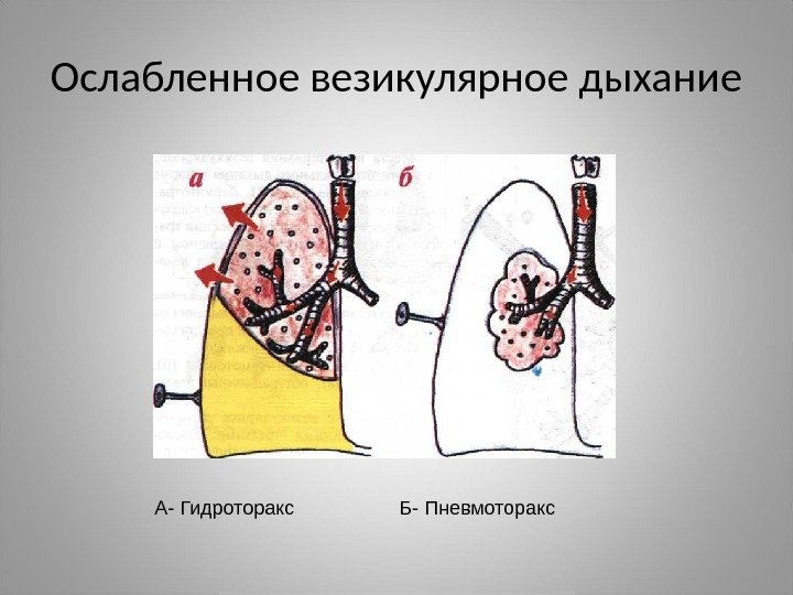 Ослабленное везикулярное дыхание А- Гидроторакс    Б- Пневмоторакс 