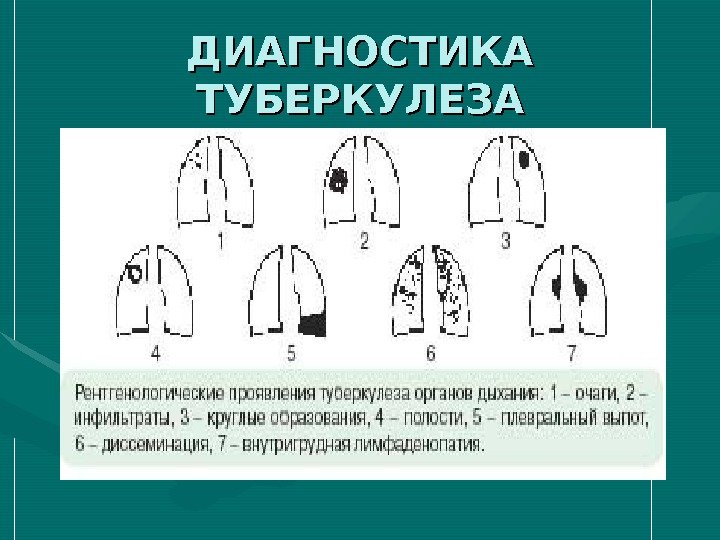 ДИАГНОСТИКА ТУБЕРКУЛЕЗА 