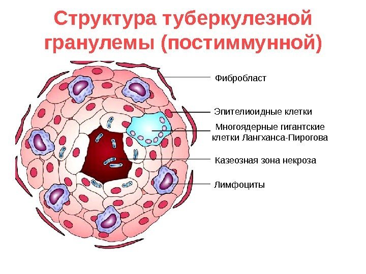   Структура туберкулезной гранулемы (постиммунной) Фибробласт Многоядерные гигантские клетки Лангханса-Пирогова Эпителиоидные клетки Лимфоциты