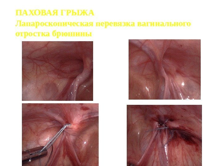 ПАХОВАЯ ГРЫЖА  Лапароскопическая перевязка вагинального отростка брюшины 