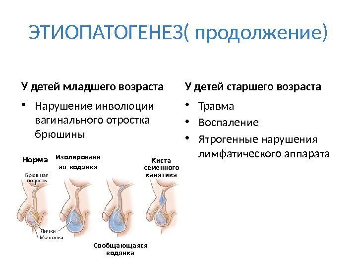 ЭТИОПАТОГЕНЕЗ( продолжение) У детей младшего возраста • Нарушение инволюции вагинального отростка брюшины У детей