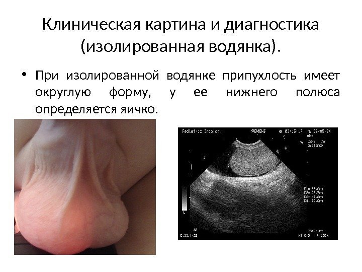 Клиническая картина и диагностика (изолированная водянка).  • При изолированной водянке припухлость имеет округлую