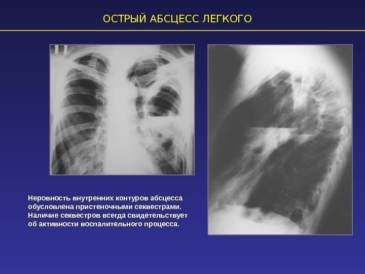 ОСТРЫЙ АБСЦЕСС ЛЕГКОГО Неровность внутренних контуров абсцесса обусловлена пристеночными секвестрами.  Наличие секвестров всегда