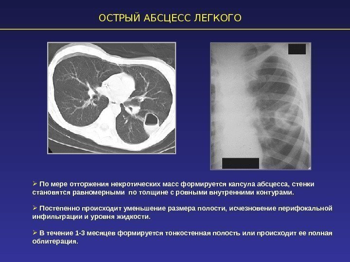 ОСТРЫЙ АБСЦЕСС ЛЕГКОГО  По мере отторжения некротических масс формируется капсула абсцесса, стенки становятся