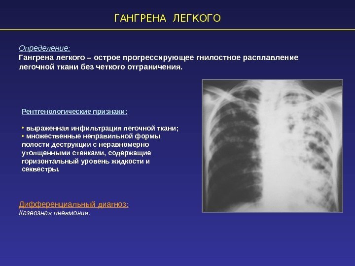 ГАНГРЕНА ЛЕГКОГО Определение: Гангрена легкого – острое прогрессирующее гнилостное расплавление легочной ткани без четкого