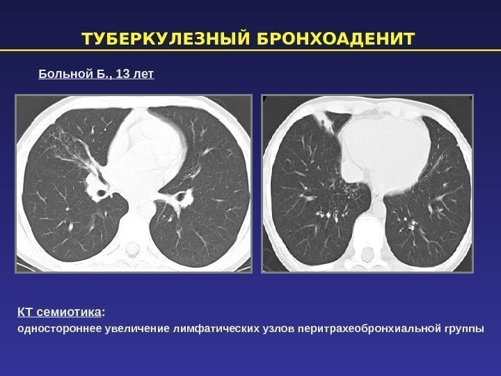 ТУБЕРКУЛЕЗНЫЙ БРОНХОАДЕНИТ КТ семиотика :  одностороннее увеличение лимфатических узлов перитрахеобронхиальной группы  