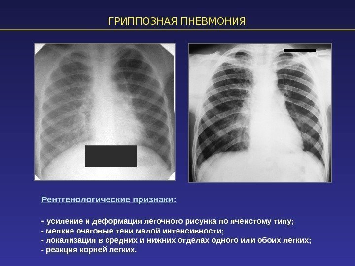 ГРИППОЗНАЯ ПНЕВМОНИЯ Рентгенологические признаки: - усиление и деформация легочного рисунка по ячеистому типу; -