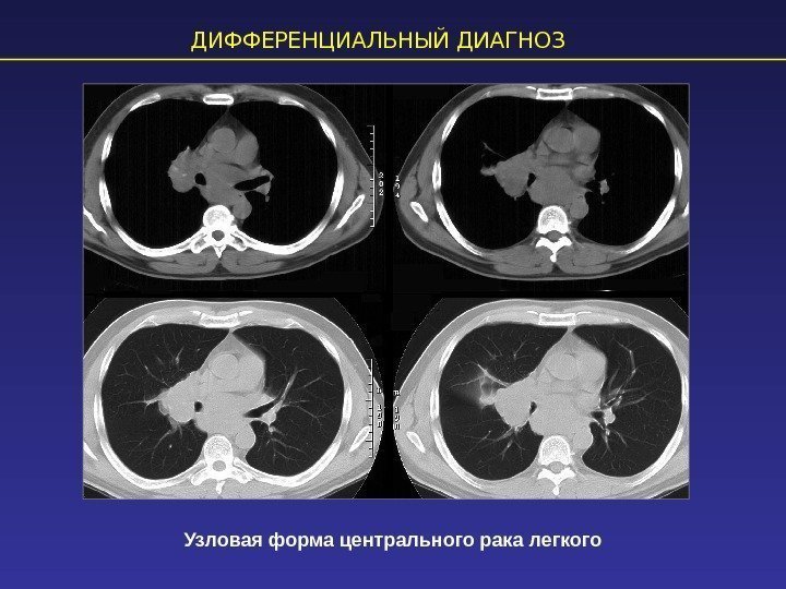 ДИФФЕРЕНЦИАЛЬНЫЙ ДИАГНОЗ Узловая форма центрального рака легкого 