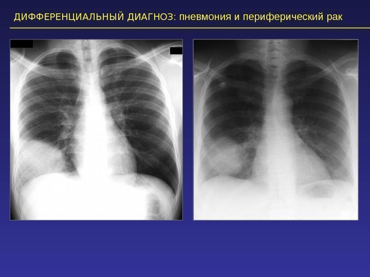 ДИФФЕРЕНЦИАЛЬНЫЙ ДИАГНОЗ :  пневмония и периферический рак 