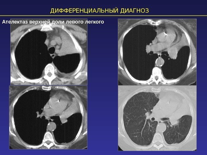 ДИФФЕРЕНЦИАЛЬНЫЙ ДИАГНОЗ Ателектаз верхней доли левого легкого 