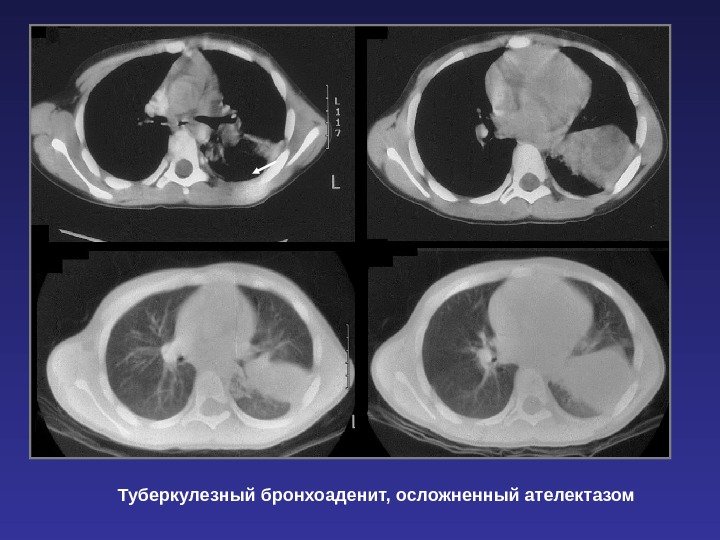 Туберкулезный бронхоаденит, осложненный ателектазом 