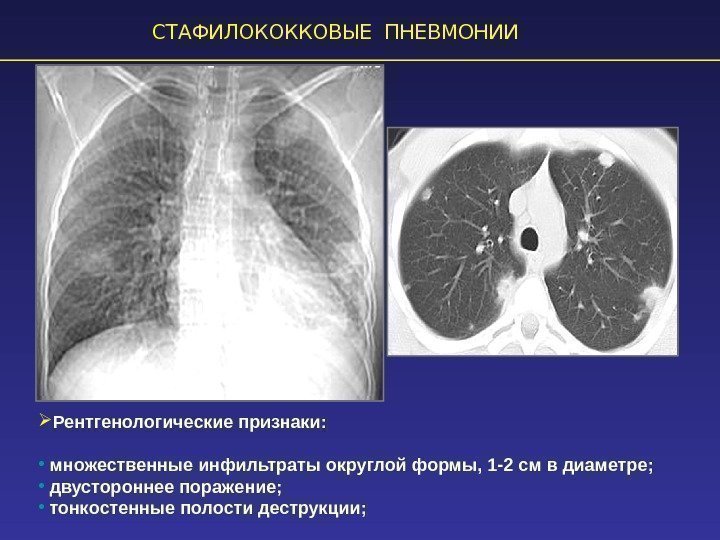 СТАФИЛОКОККОВЫЕ ПНЕВМОНИИ Рентгенологические признаки:  •  множественные инфильтраты округлой формы, 1 -2 см