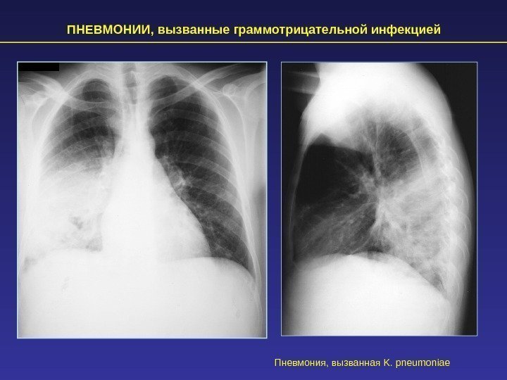 ПНЕВМОНИИ, вызванные граммотрицательной инфекцией Пневмония, вызванная K. pneumoniae 
