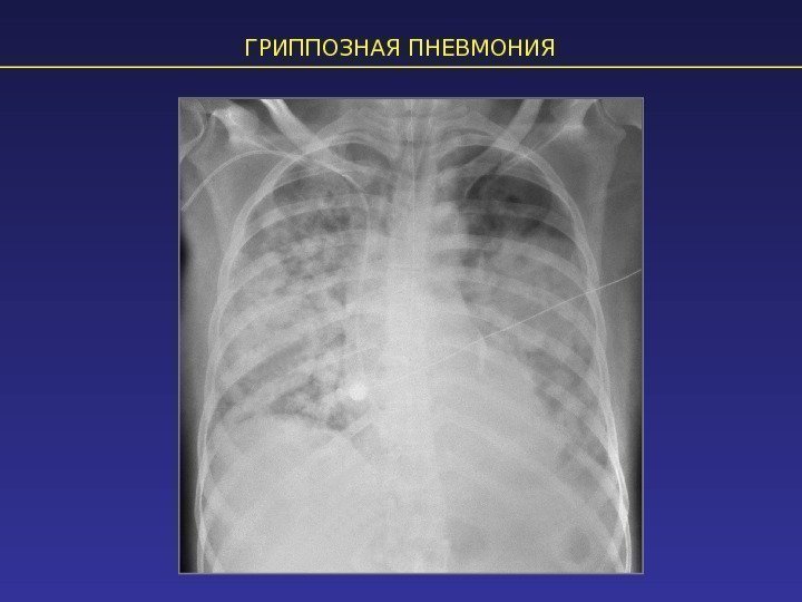 ГРИППОЗНАЯ ПНЕВМОНИЯ 