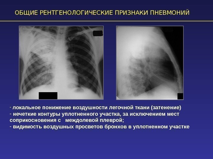 ОБЩИЕ РЕНТГЕНОЛОГИЧЕСКИЕ ПРИЗНАКИ ПНЕВМОНИЙ -  локальное понижение воздушности легочной ткани (затенение) - 