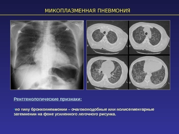 МИКОПЛАЗМЕННАЯ ПНЕВМОНИЯ Рентгенологические признаки:  • по типу бронхопневмонии – очаговоподобные или полисегментарные затемнения