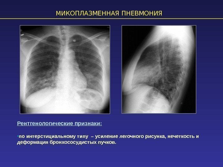 МИКОПЛАЗМЕННАЯ ПНЕВМОНИЯ Рентгенологические признаки:  • по интерстициальному типу – усиление легочного рисунка, нечеткость