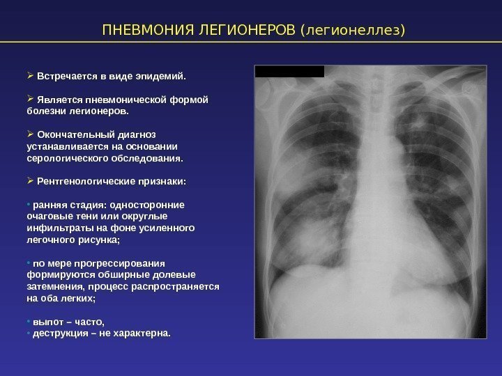 ПНЕВМОНИЯ ЛЕГИОНЕРОВ (легионеллез)  Встречается в виде эпидемий. Является пневмонической формой болезни легионеров. Окончательный