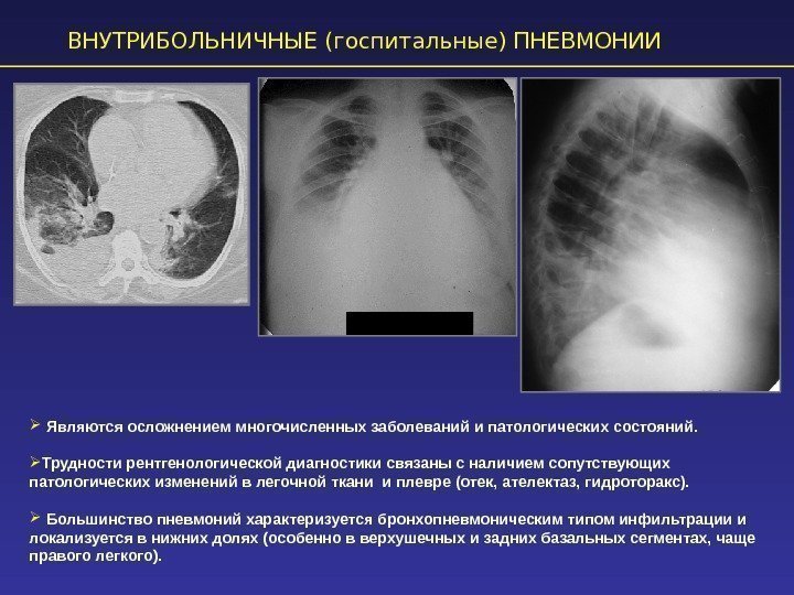 ВНУТРИБОЛЬНИЧНЫЕ (госпитальные) ПНЕВМОНИИ  Являются осложнением многочисленных заболеваний и патологических состояний.  Трудности рентгенологической