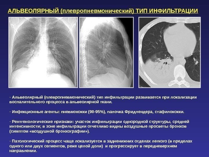 АЛЬВЕОЛЯРНЫЙ (плевропневмонический) ТИП ИНФИЛЬТРАЦИИ -  Альвеолярный (плевропневмонический) тип инфильтрации развивается при локализации воспалительного