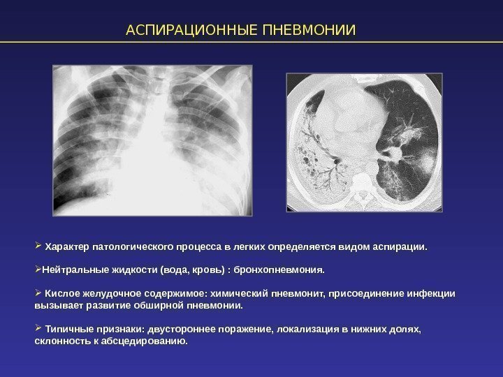 АСПИРАЦИОННЫЕ ПНЕВМОНИИ  Характер патологического процесса в легких определяется видом аспирации.  Нейтральные жидкости