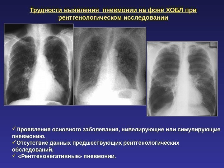 Трудности выявления пневмонии на фоне ХОБЛ при рентгенологическом исследовании Проявления основного заболевания, нивелирующие или