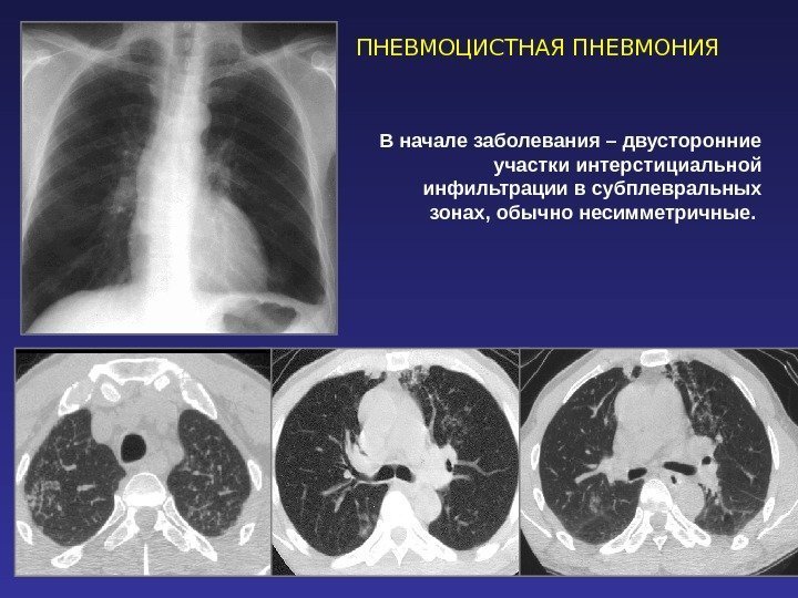 ПНЕВМОЦИСТНАЯ ПНЕВМОНИЯ В начале заболевания – двусторонние участки интерстициальной инфильтрации в субплевральных зонах, обычно