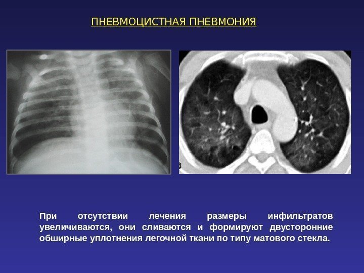 ПНЕВМОЦИСТНАЯ ПНЕВМОНИЯ При отсутствии лечения размеры инфильтратов увеличиваются,  они сливаются и формируют двусторонние