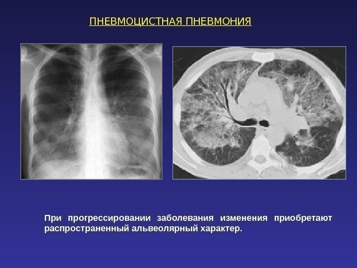 ПНЕВМОЦИСТНАЯ ПНЕВМОНИЯ При прогрессировании заболевания изменения приобретают распространенный альвеолярный характер.  