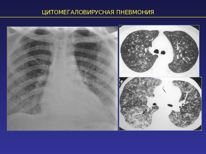 ЦИТОМЕГАЛОВИРУСНАЯ ПНЕВМОНИЯ 