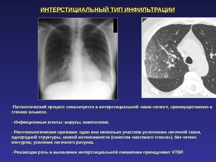 ИНТЕРСТИЦИАЛЬНЫЙ ТИП ИНФИЛЬТРАЦИИ - Патологический процесс локализуется в интерстициальной ткани легкого, преимущественно в стенках