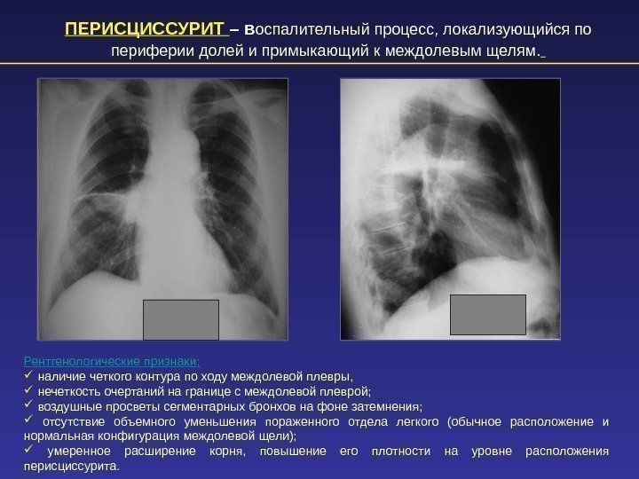 ПЕРИСЦИССУРИТ – в оспалительный процесс, локализующийся по периферии долей и примыкающий к междолевым щелям.