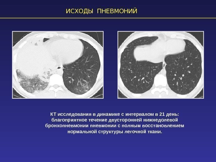 КТ исследования в динамике с интервалом в 21 день:  благоприятное течение двусторонней нижнедолевой