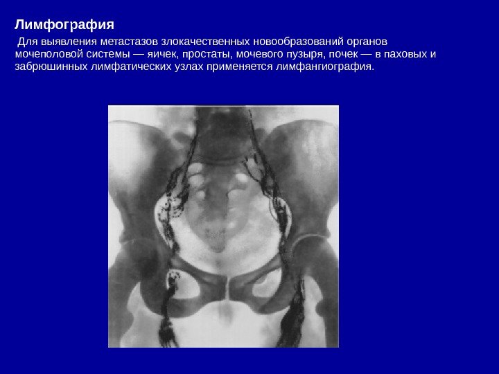 Лимфография  Для выявления метастазов злокачественных новообразований органов мочеполовой системы — яичек, простаты, мочевого