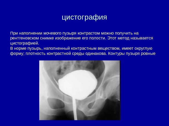 цистография При наполнении мочевого пузыря контрастом можно получить на рентгеновском снимке изображение его полости.