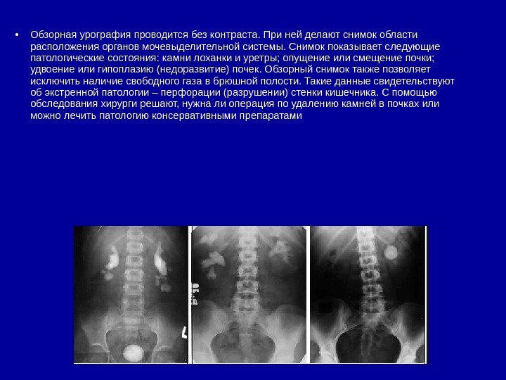  • Обзорная урография проводится без контраста. При ней делают снимок области расположения органов