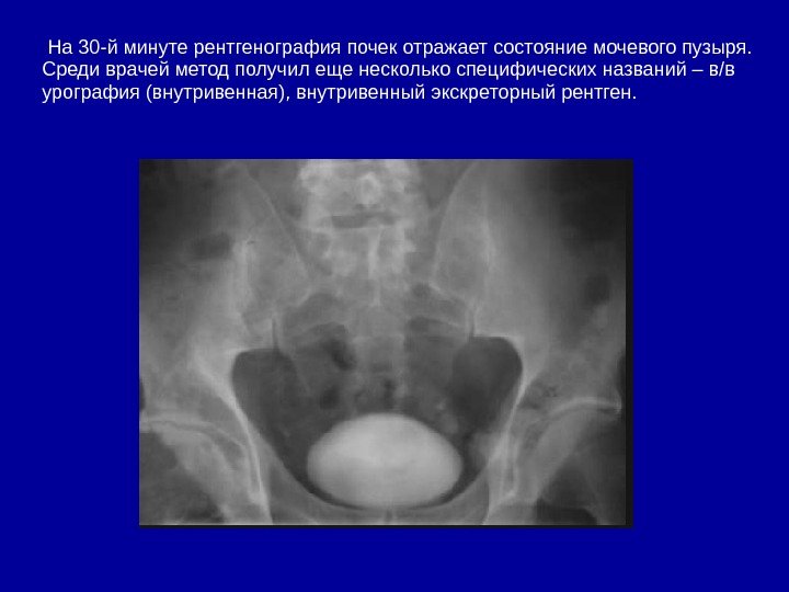  На 30 -й минуте рентгенография почек отражает состояние мочевого пузыря.  Среди врачей